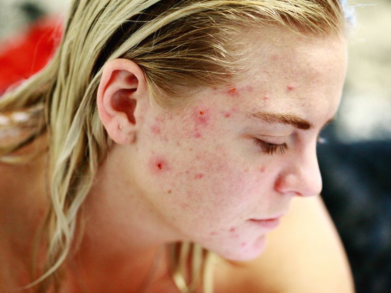acné-maladie-bénigne-peau